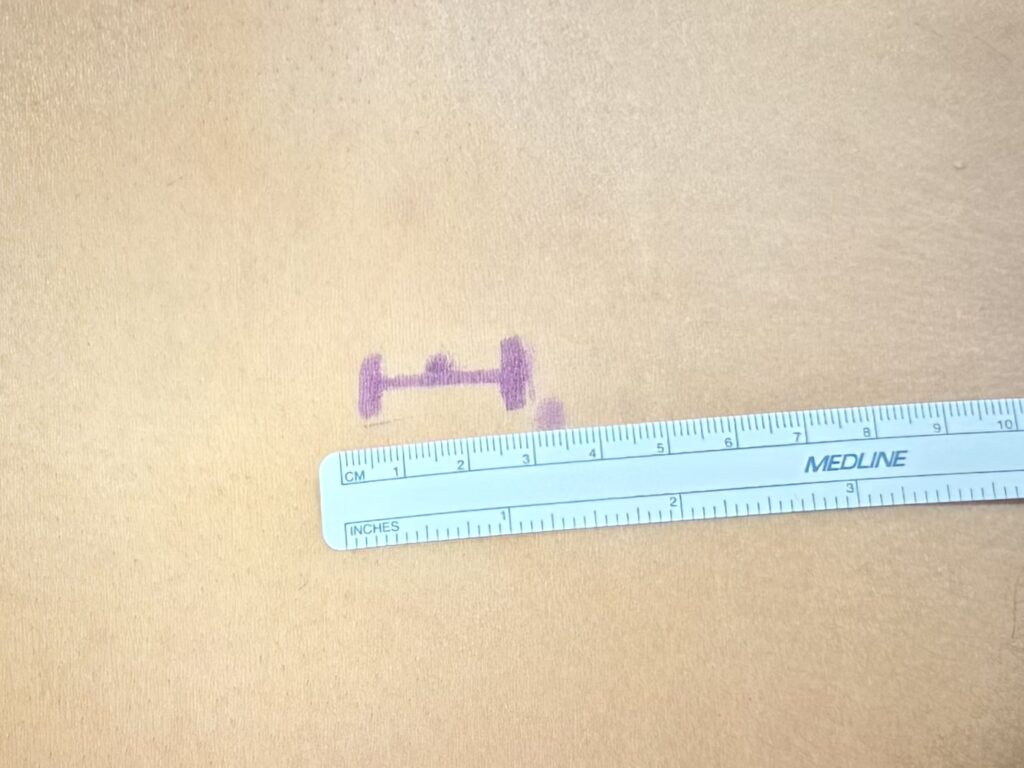Incisión en cirugía de hernia de disco